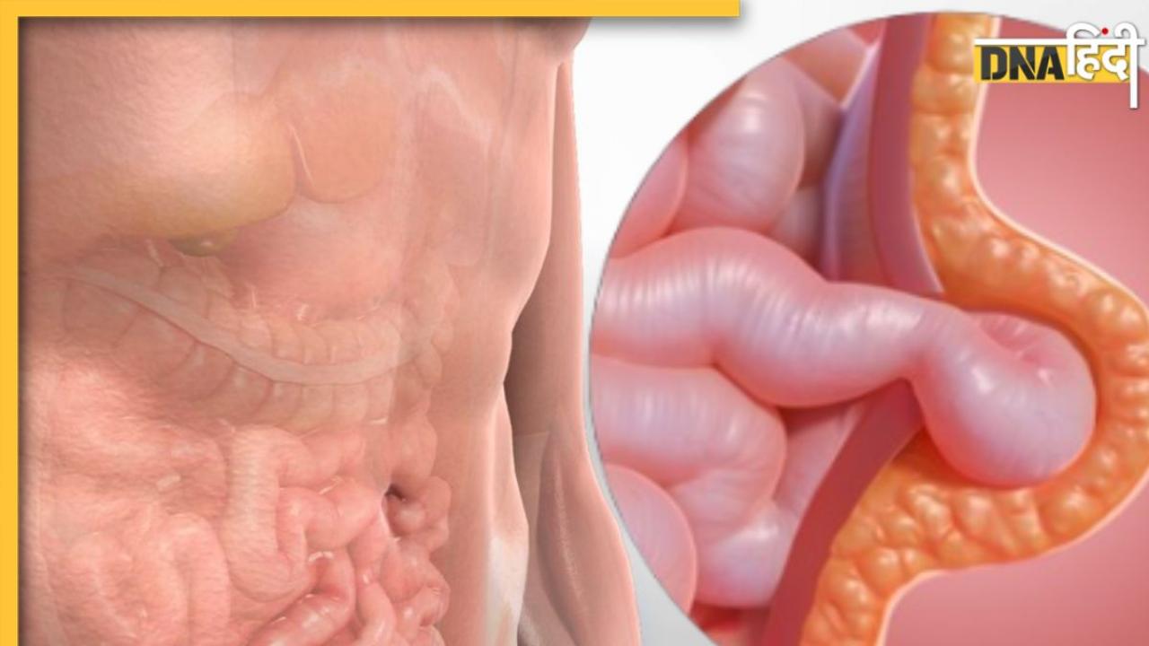 Hernia Symptoms: क्या है हर्निया? पेट में दर्द-सूजन बन सकता है इस बड़ी बीमारी का कारण, जानें लक्षण और इलाज