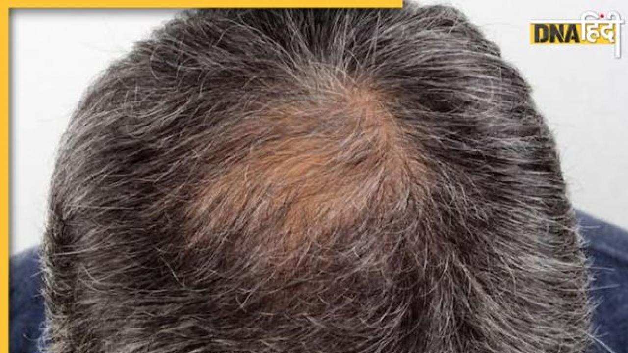 Hair Loss Remedy: ये 6 जड़ी-बूटियां गंजी हो चुकी खोपड़ी पर उगा देती हैं बाल, Hair Loss की है ये बेस्ट रेमेडी