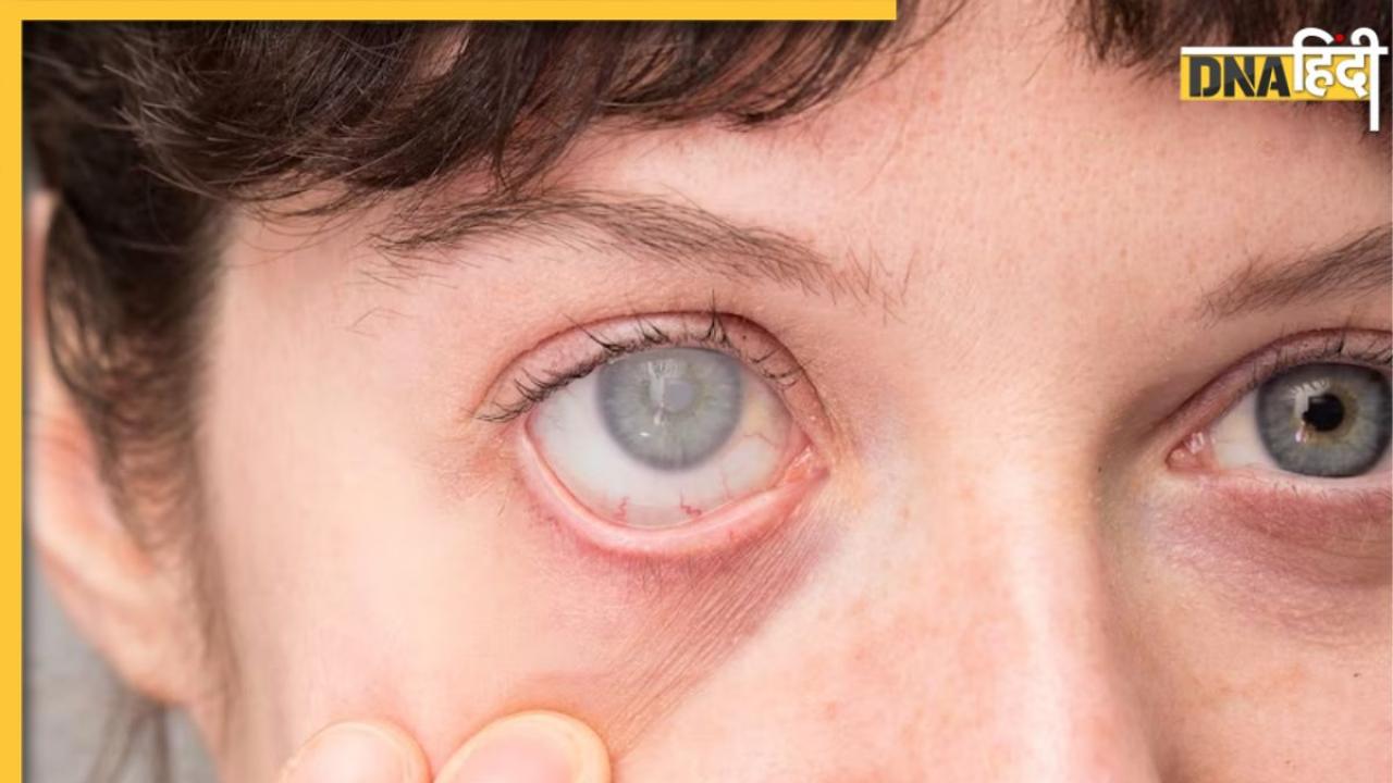 World Glaucoma Day 2024: आंखों की रोशनी छीन अंधा बना सकता है काला मोतिया, जानें क्या हैं इसके लक्षण और बचाव के उपाय 