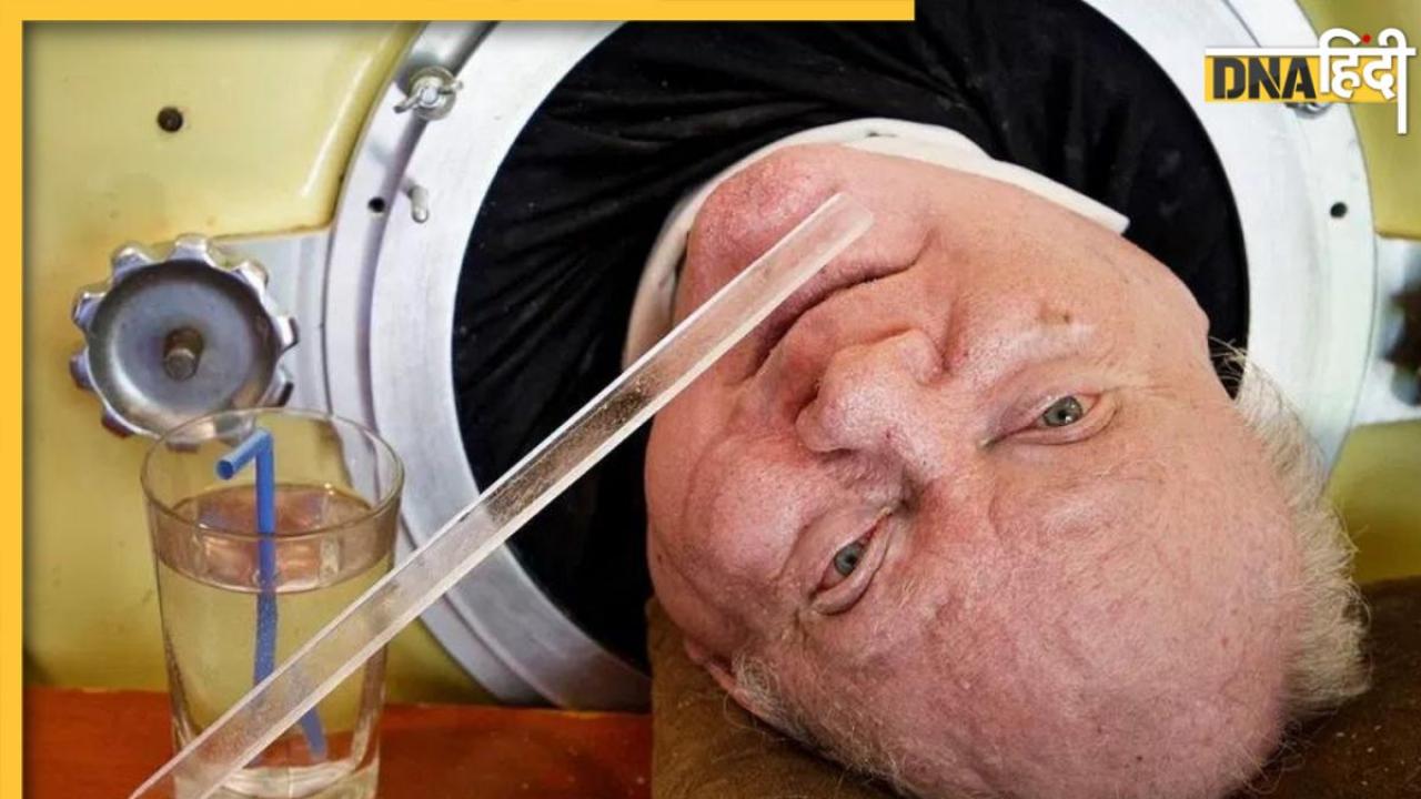 72 साल तक लोहे के फेफड़ों से सांस लेते रहे Paul Alexander, आखिर में इस बीमारी ने ले ली जान
