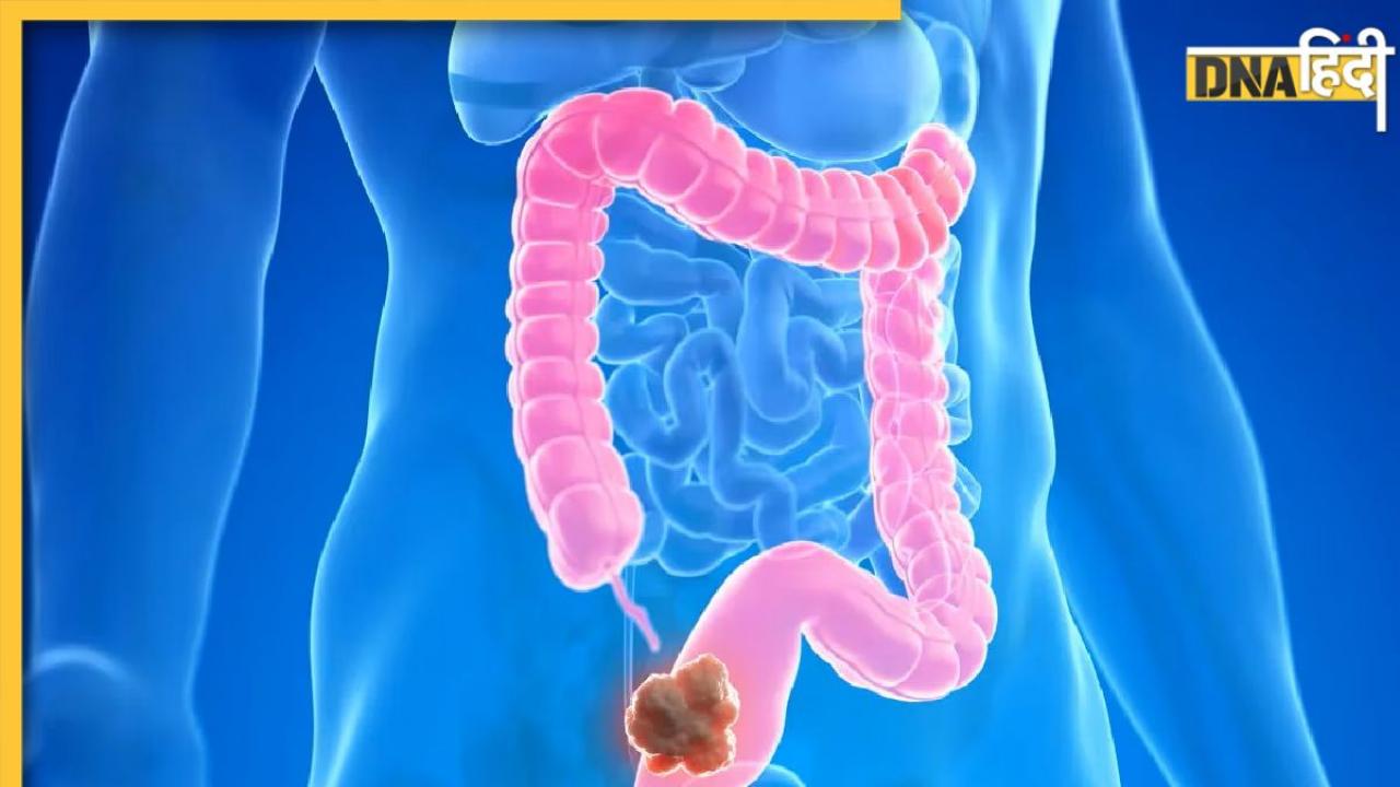 Stomach Cancer Symptoms: शरीर में दिखने वाले ये बदलाव कोलन कैंसर का लक्षण हो सकते हैं