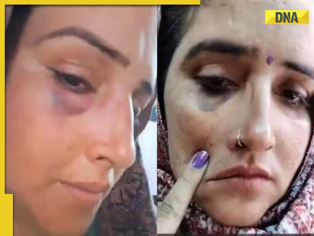 Seema Haider assaulted? Viral video shows brutal injury marks