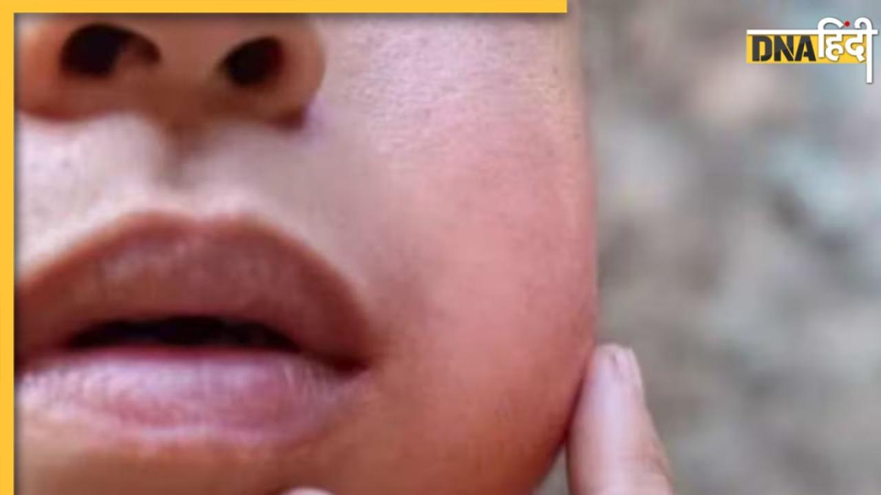 राजस्थान में बढ़े Mumps के मामले, जानें क्या हैं गाल पर अटैक करने वाली इस बीमारी के लक्षण