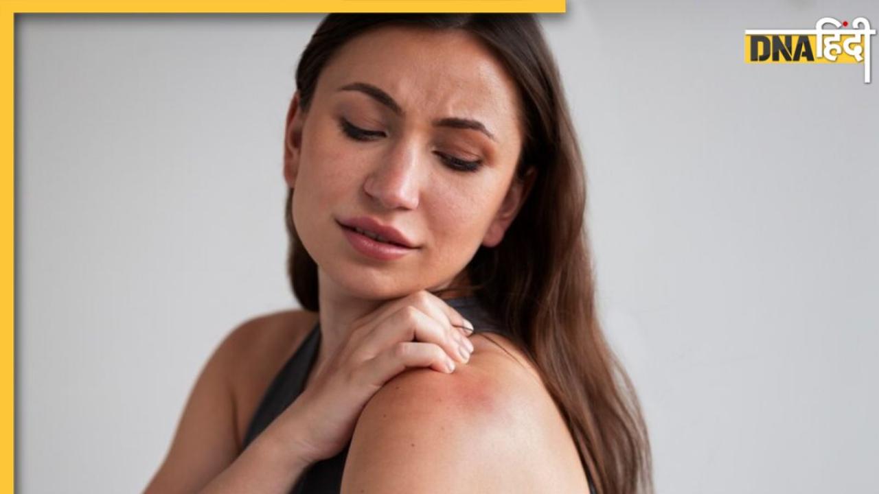 Heat Rash Remedy: गर्मी में घमौरियों से होने लगी है भयंकर खुजली और जलन? इन आयुर्वेदिक उपायों से जल्द मिलेगा आराम