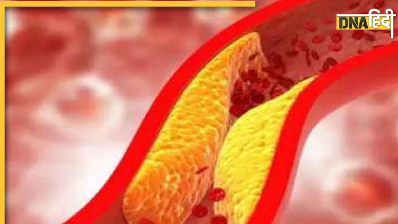 Good cholesterol Remedy: ये 10 चीजें धमनियों में फंसे कोलेस्ट्रॉल को खींचकर बाहर लाती हैं, नसों की ब्लॉकेज होगी खत्म