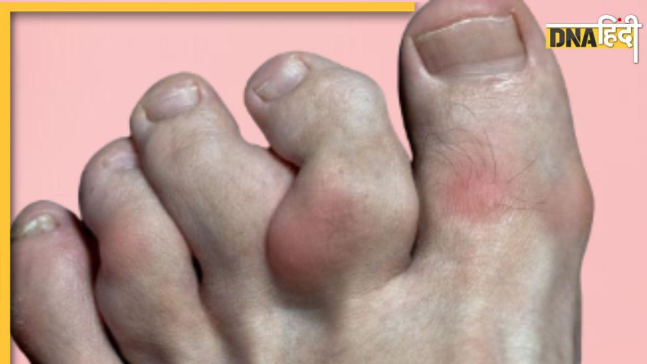 Psoriatic Arthritis: इस बीमारी के कारण अजीब ढंग से मुड़ने लगती हैं हाथ-पैर की उंगलियां, लक्षण दिखते ही करें ये काम