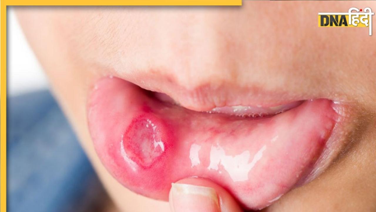 White Blister Risk: सफेद छाले इस गंभीर स्थिति का हैं संकेत, जानिए किन वजहों से पकता है मुंह
