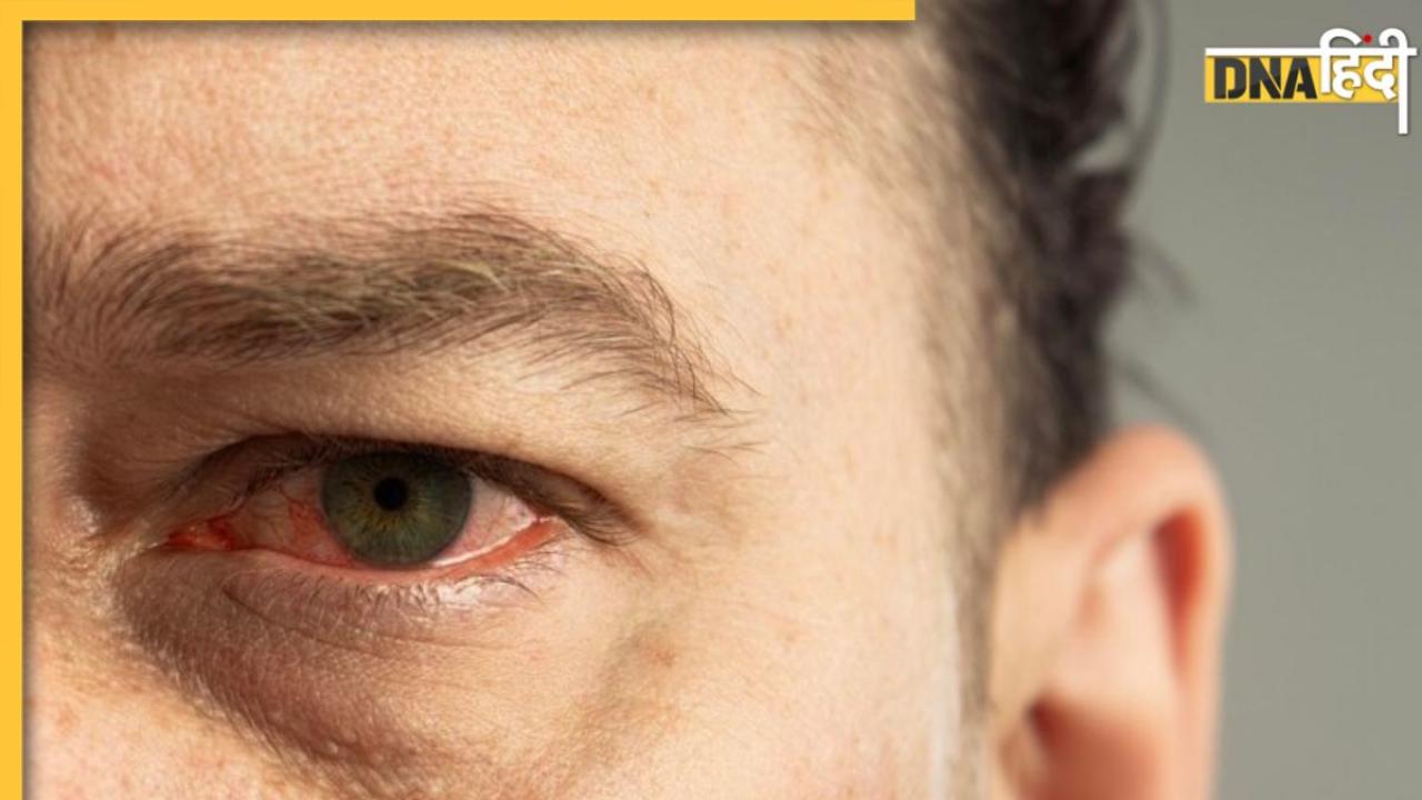 Redness In Eyes: गर्मी में इन 7 कारणों से आंखें होने लगती हैं लाल, इससे राहत दिला सकते हैं ये आसान टिप्स