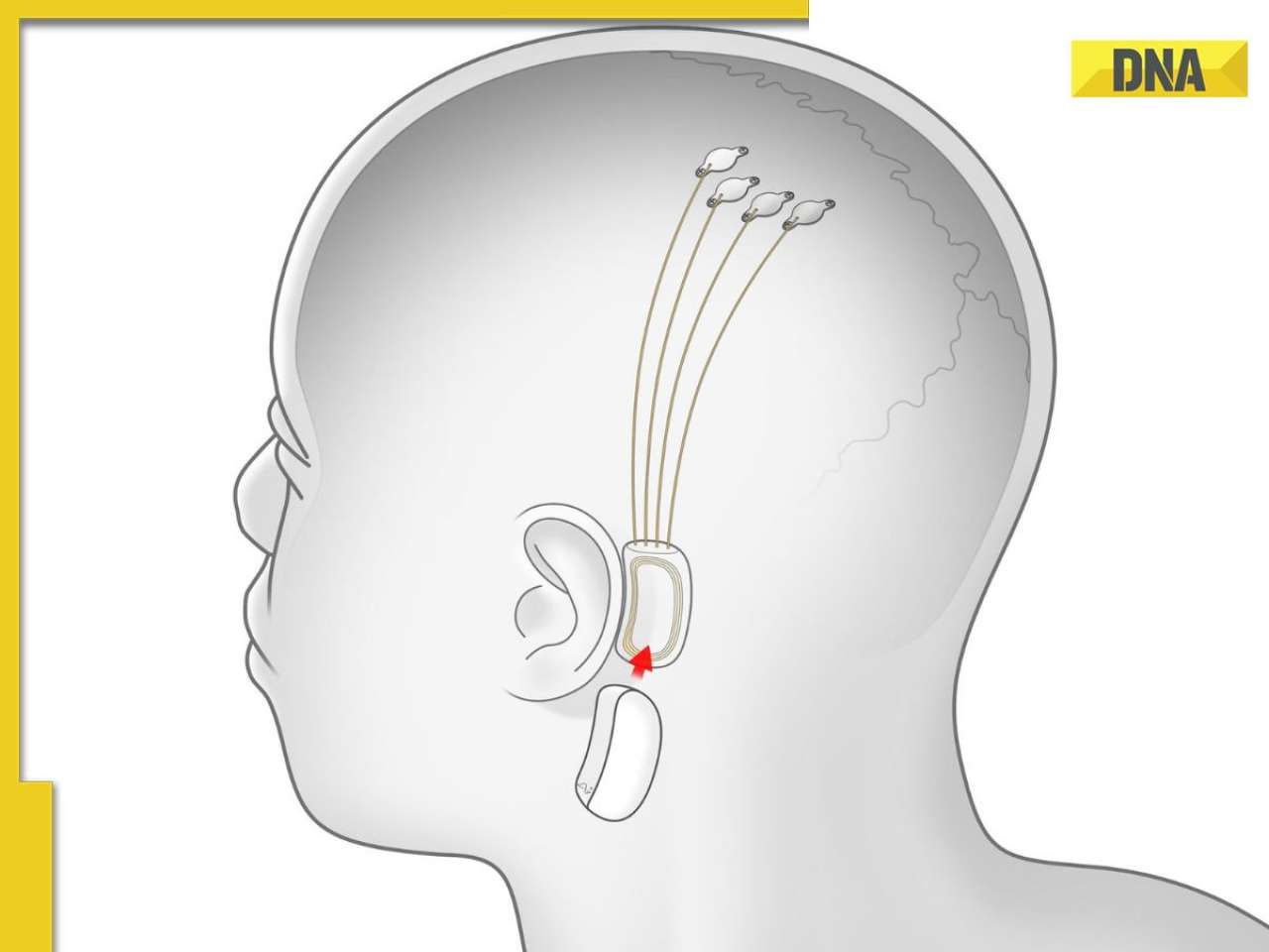 Elon Musk's Neuralink accepting applications for chip implant