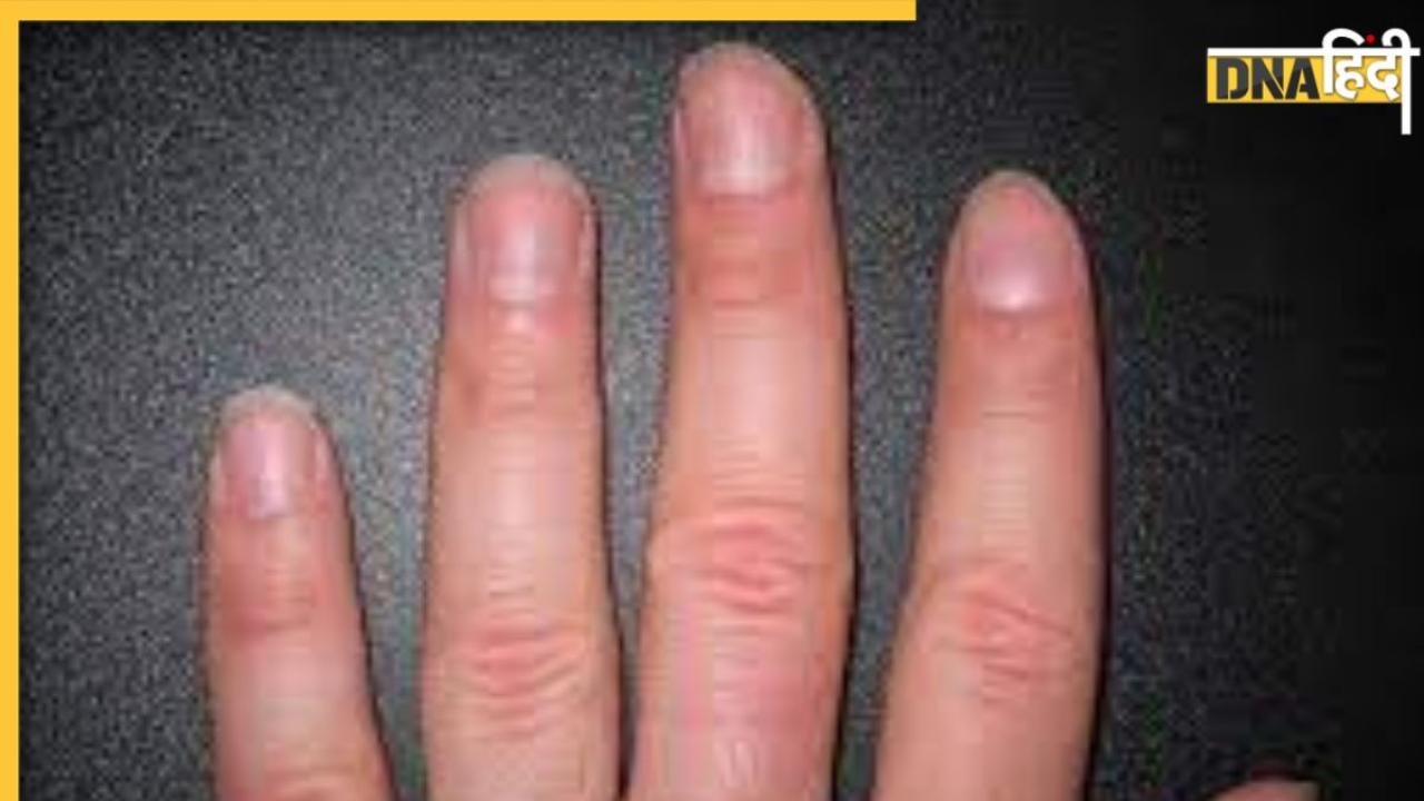 Changes in Nails: नाखूनों में होने वाला ये बदलाव बताएगा कहीं कैंसर का संकेत तो नहीं? 
