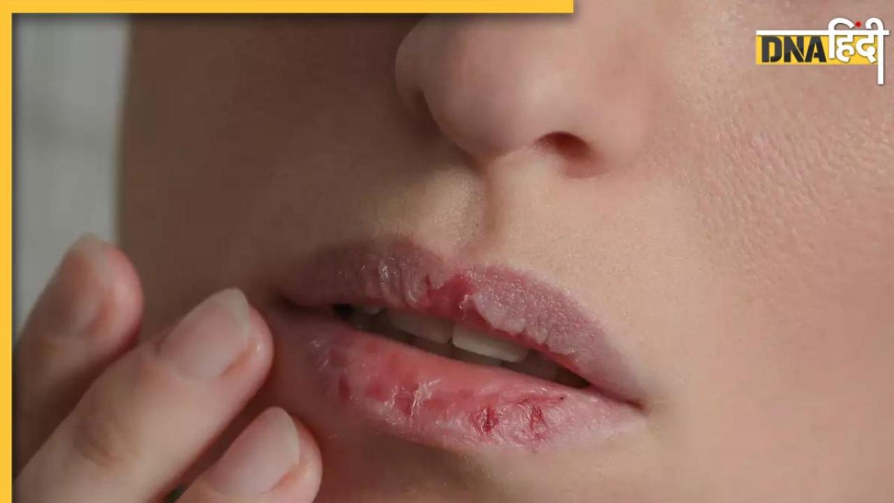 Chapped Lips Remedy: गर्मी में होंठों का फटना या खून आना, शरीर में इस कमी का देता है संकेत