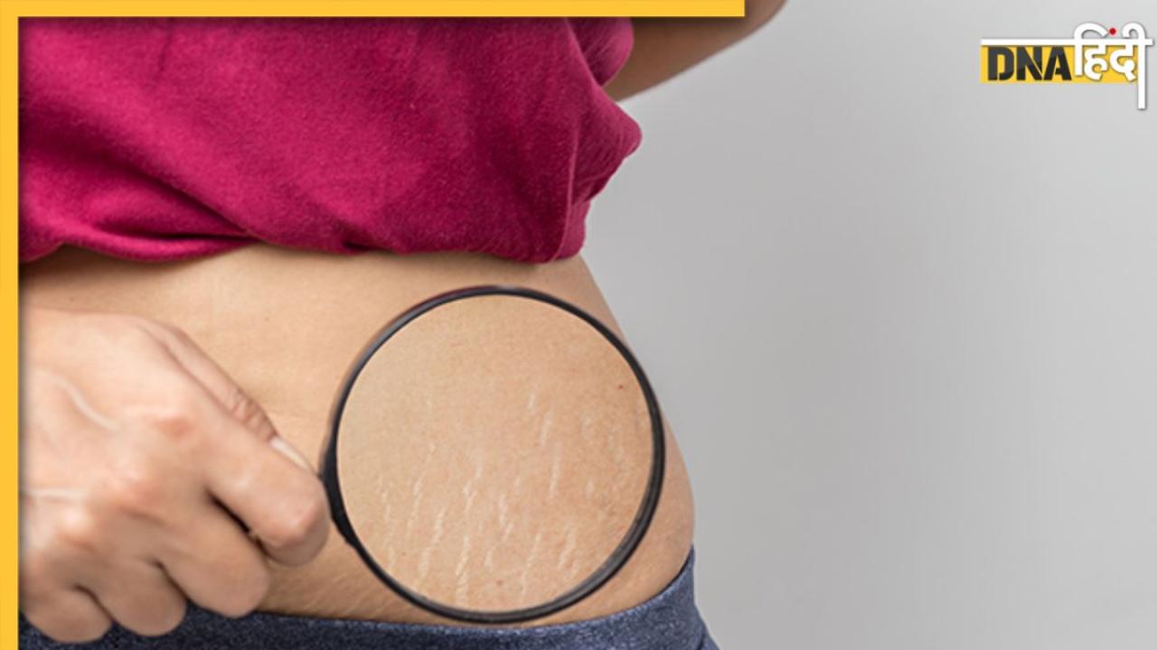 Stretch Marks Treatment: अब नहीं छुपाने पड़ेंगे स्ट्रेच मार्क्स, इन 5 आसान उपायों से दूर होंगे सारे निशान