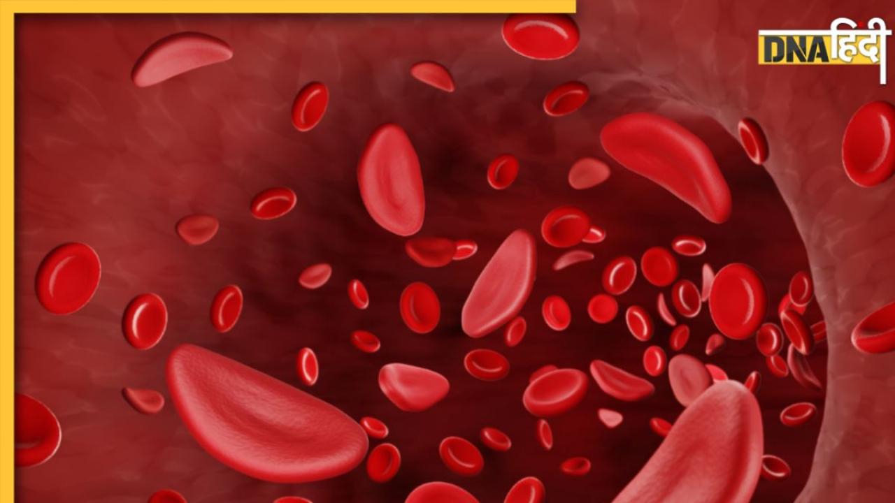 क्या है Sickle Cell की बीमारी? बचपन में ही दिखने लगते हैं इस जेनेटिक रोग के लक्षण