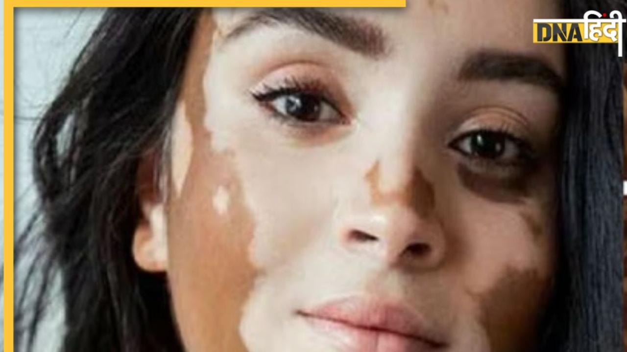 Vitiligo aka Safed Daag Symptoms: नहीं बदलीं ये आदतें तो सफेद दाग होने की बढ़ जाएगी संभावना, ऐसे होती है इस बीमारी की शुरुआत