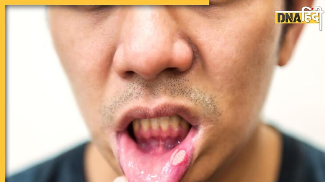 Mouth Ulcers Remedies: मुंह में छालों से हैं परेशान तो ये 3 चीजें दिखाएंगी असर, झट से मिलेगा आराम