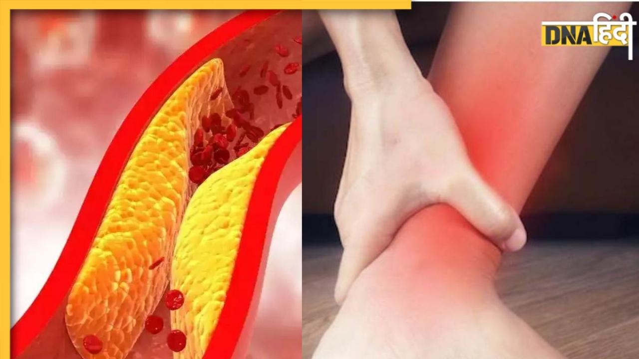 High Cholesterol का संकेत है शरीर के इन हिस्सों में होने वाला दर्द, न करें अनदेखा