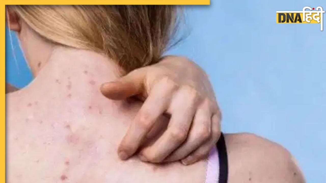 क्या छोटे-छोटे दानों से भरी पड़ी है पीठ? जानें Back Acne का कारण और बचाव के उपाय