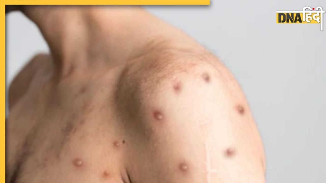 क्या Chickenpox की वैक्सीन ले चुके लोगों में नहीं है Monkeypox Virus का खतरा? 