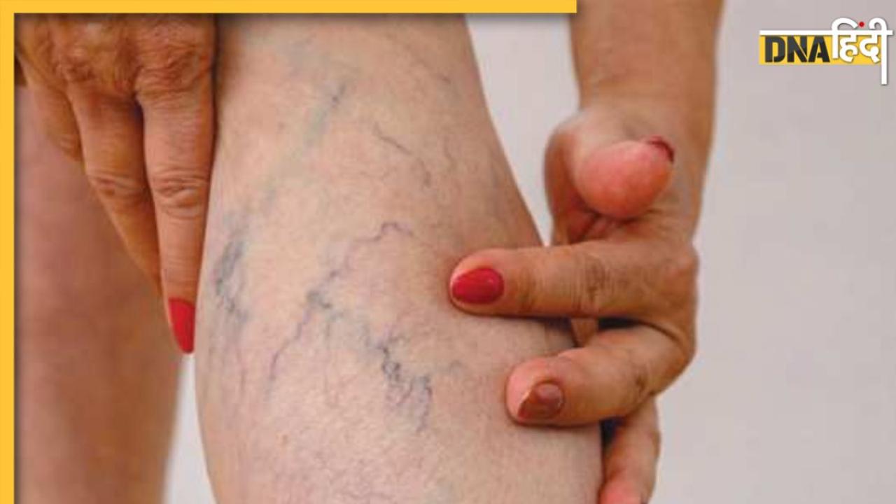 पैरों में नजर आ रही हैं नीली नसें तो हो गई है Varicose Veins की समस्या, इन 4 एक्सरसाइज से करें दूर