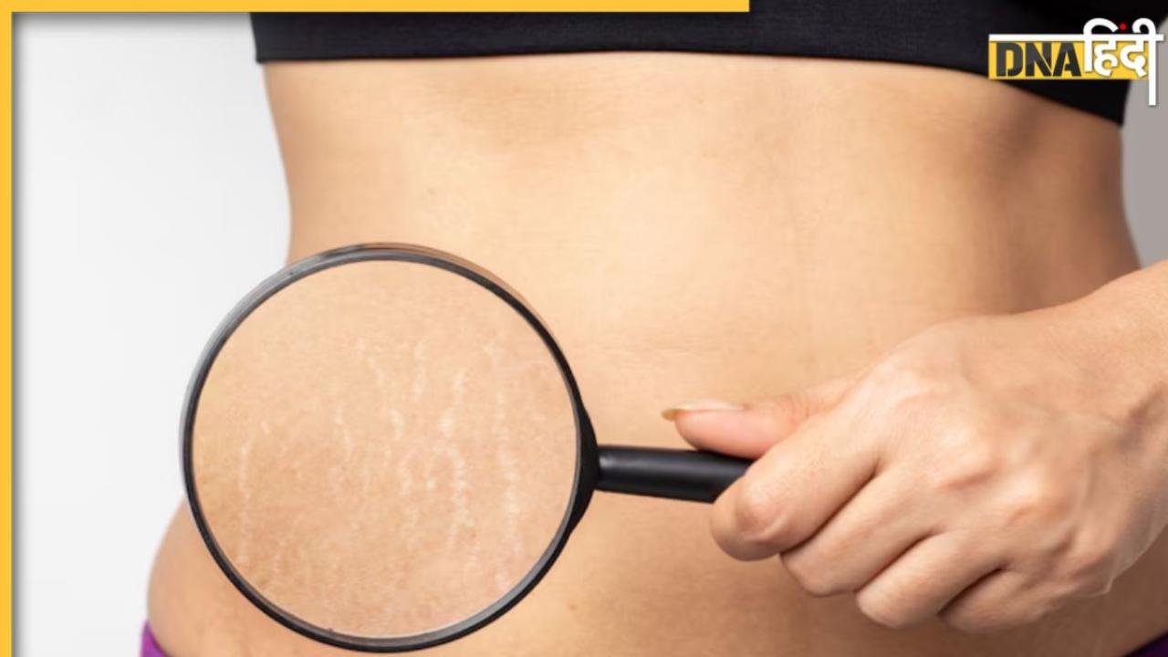 Stretch Marks से हमेशा के लिए मिल जाएगा छुटकारा, बस अपनाएं ये घरेलू उपाय