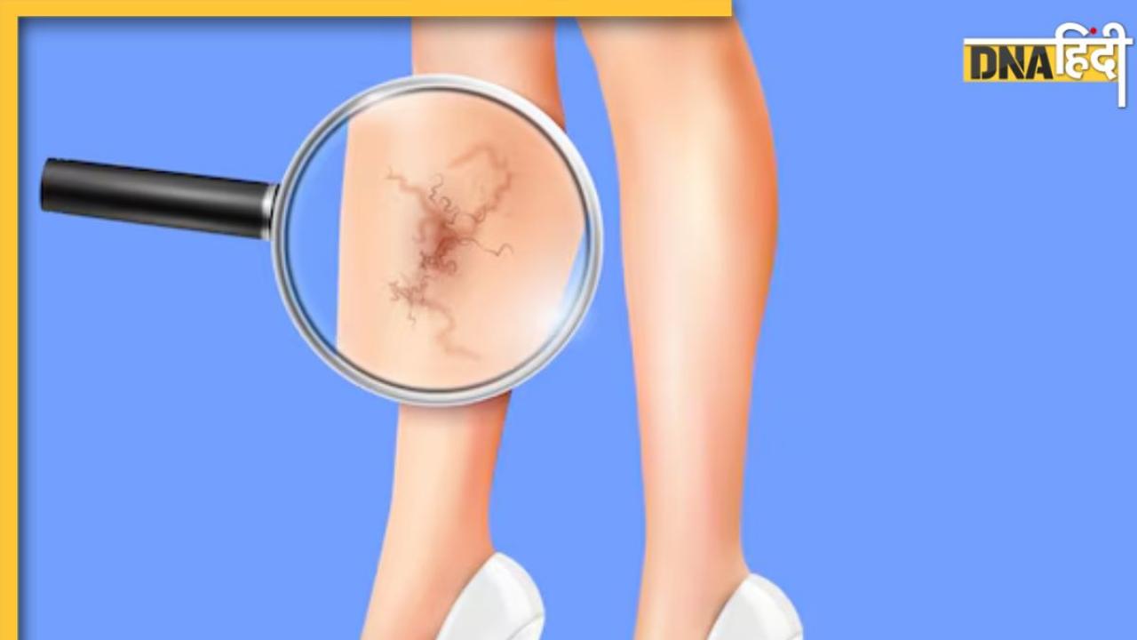 Varicose Veins: हाथ और पैरों में दिख रही हैं उभरी हुई नीली-बैंगनी नसें? कहीं आप इस गंभीर बीमारी के शिकार तो नहीं