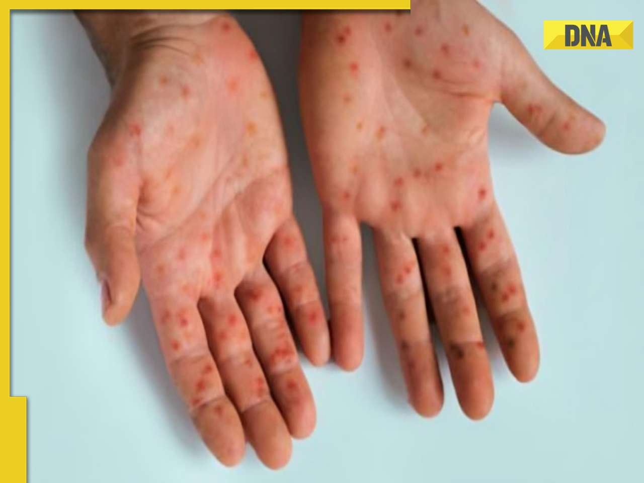 Mpox outbreak: 5 tips to prevent yourself from monkeypox virus