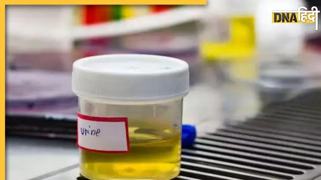 Uric Acid Signs In Urine: शरीर में हाई यूरिक एसिड का संकेत देते हैं यूरिन में ये 5 बदलाव, देखते ही खुद कर लेंगे पहचान 