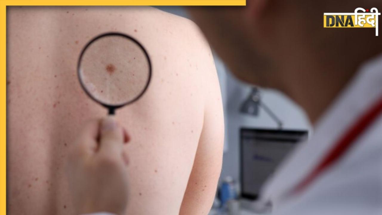 त्वचा पर दिखने वाले ये 5 लक्षण हो सकते हैं Skin Cancer के संकेत, भूलकर भी न करें नजरअंदाज