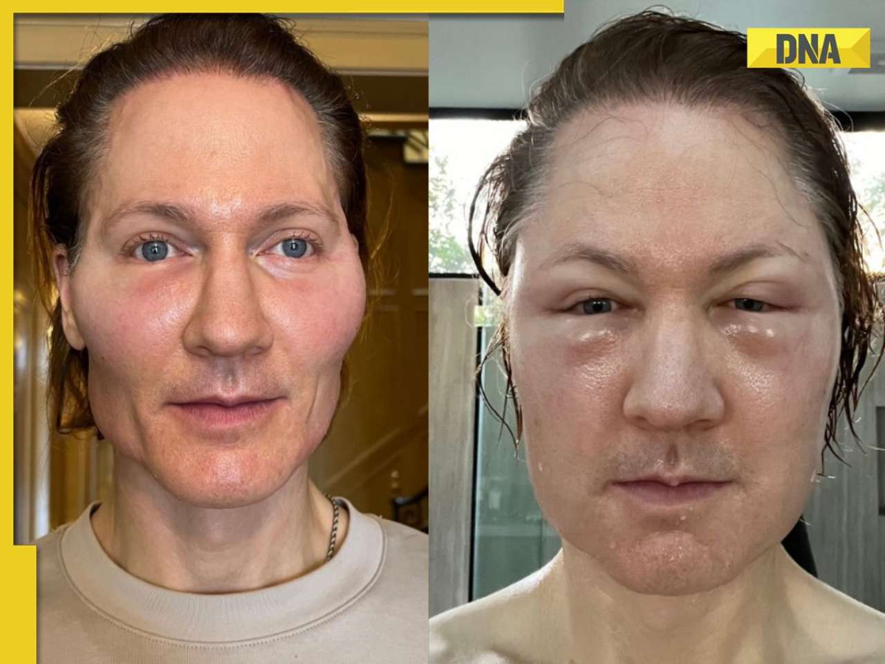 Tech millionaire Bryan Johnson's face 'blows up' after anti-aging experiment; here’s how