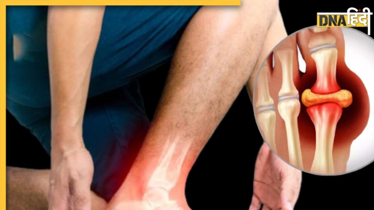जोड़ों में जमा Purine बाहर निकाल देगी ये 1 चीज, Uric Acid के मरीज डाइट में कर लें शामिल