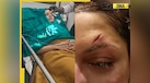  Bhagyashree suffers deep wound on her forehead, undergoes surgery, gets 13 stiches after getting injured by.... 