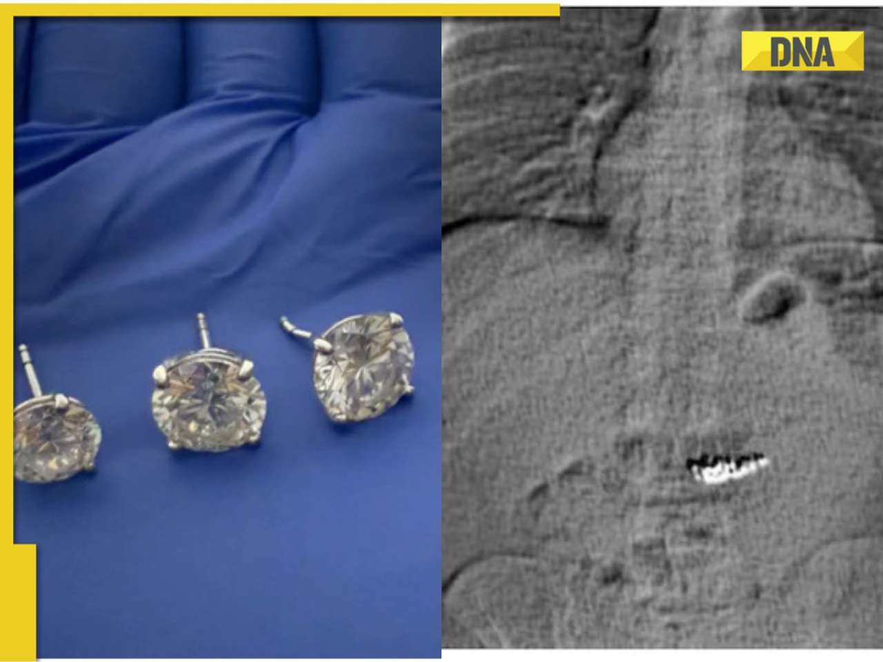 Orlando police recover $769,500 Tiffany earrings after man swallows them