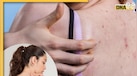 Back Acne: क्यों होती हैं पीठ पर मुंहासे, दाने और फुंसियों की समस्या? जानें कैसे करें इसे दूर