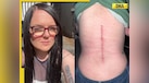  Woman in UK suffering from back pain for 10 years, turns out it was... 