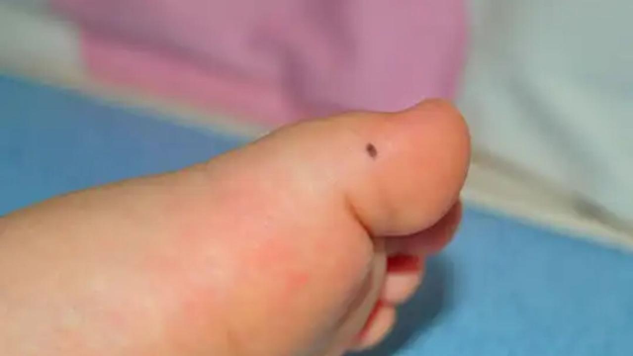 पैर के अंगूठे पर तिल