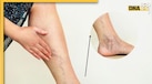 क्या है Varicose Veins? हाथ-पैरों में नजर आने लगती हैं नीली-बैंगनी उभरी हुई नसें