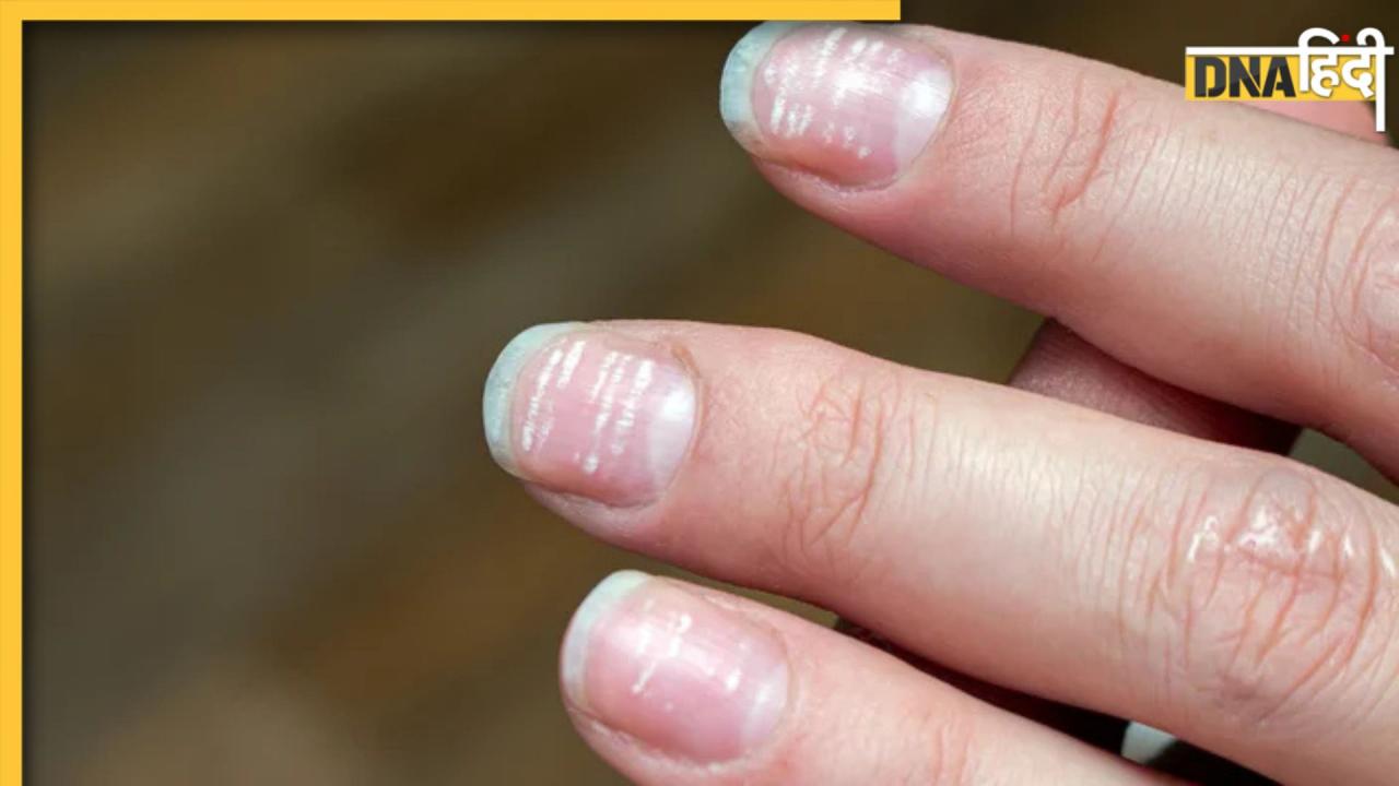 White Spots on Nails: नाखूनों पर दिखने वाली ये सफेद धारियां आपके शरीर में जन्म ले रहीं इन 5 बीमारियों का संकेत हैं