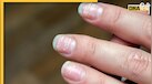 White Spots on Nails: नाखूनों पर दिखने वाली ये सफेद धारियां आपके शरीर में जन्म ले रहीं इन 5 बीमारियों का संकेत हैं