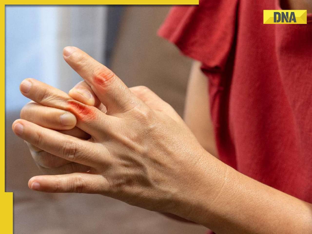 Uric acid levels too high? Know the causes, symptoms and ways to control 