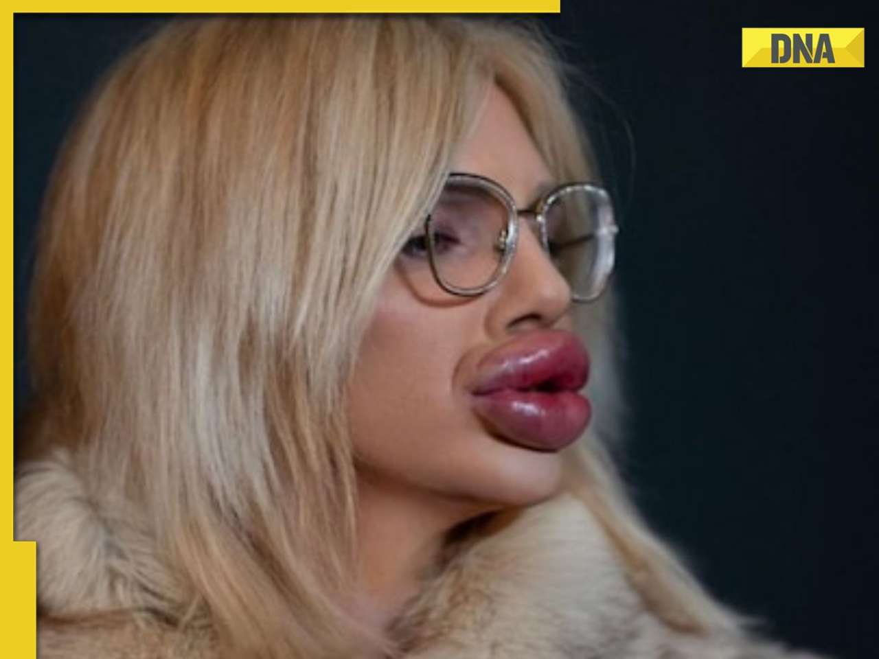 This woman spent over Rs 1.3 crore to get world’s biggest lips, says 'won’t stop until...'