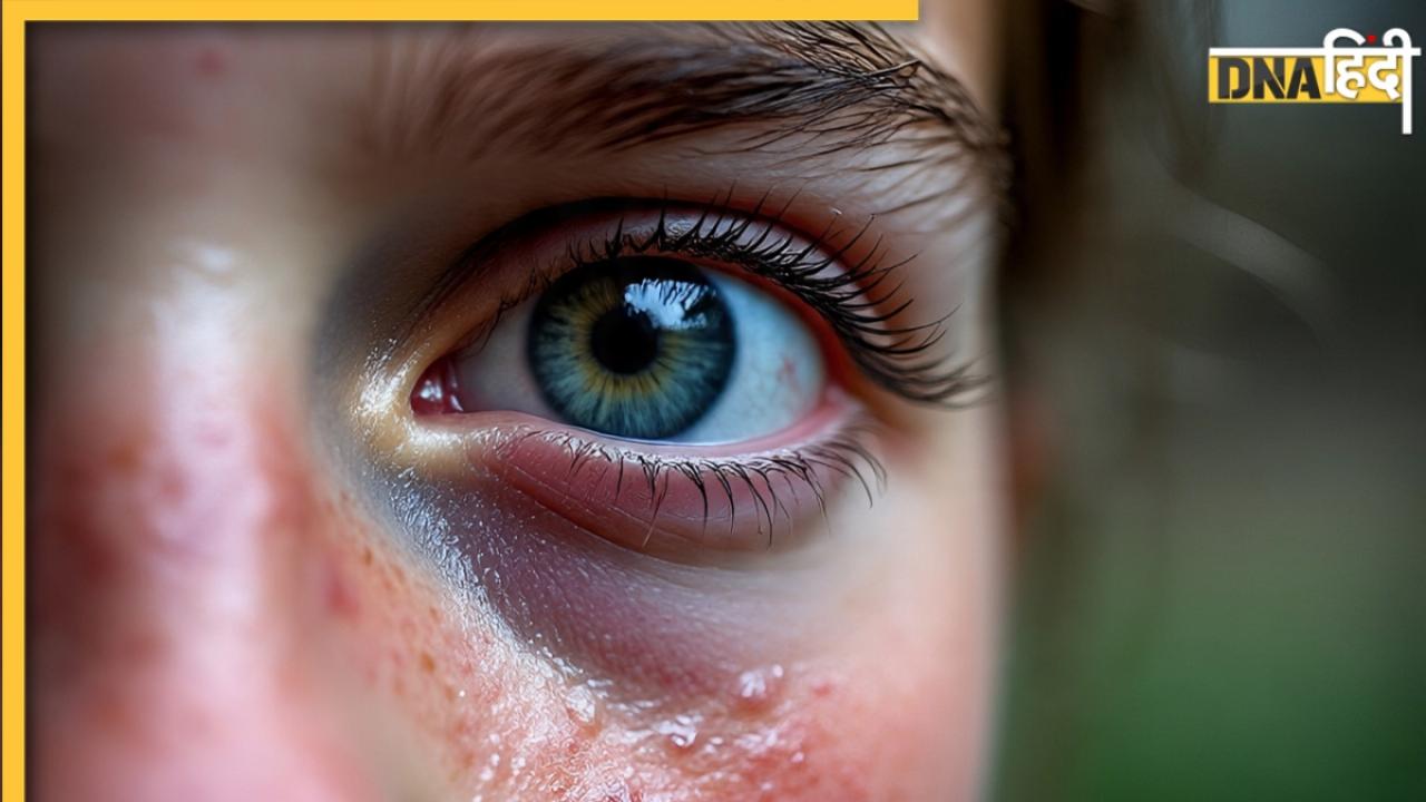 बारिश के मौसम में Eye Infection से रहना है दूर, तो अपनाएं ये 5 उपाय