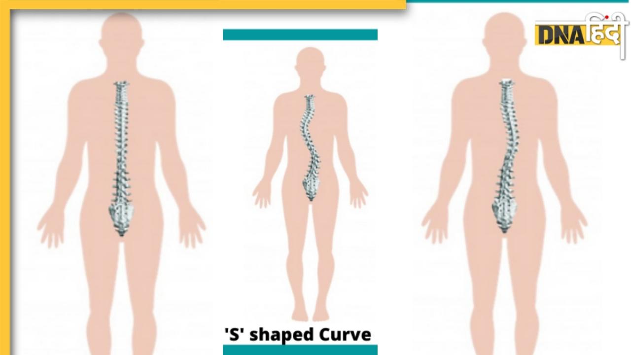 क्या है Scoliosis? जानें रीढ़ की हड्डी से जुड़ी इस खतरनाक बीमारी के लक्षण