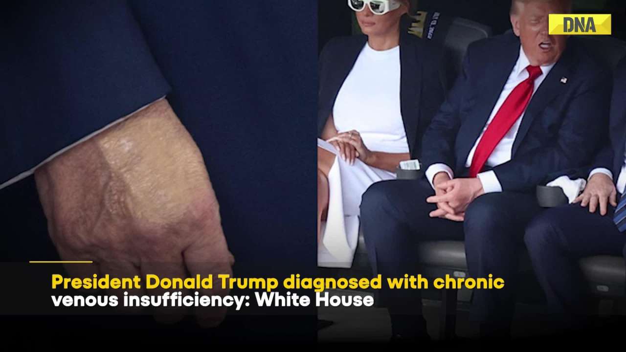  US News: President Donald Trump Diagnosed With Chronic Venous Insufficiency Confirm White House