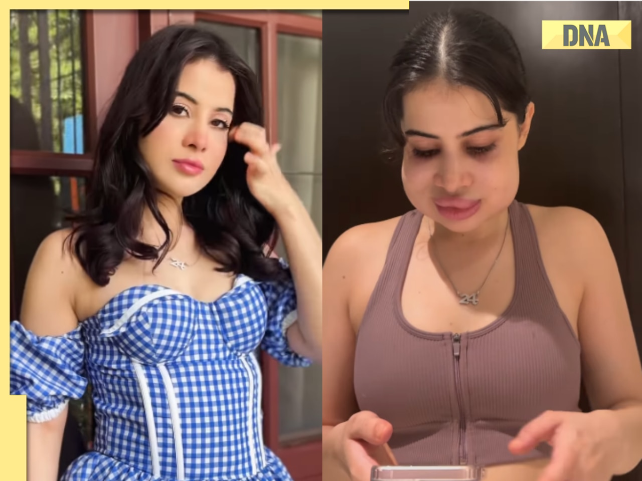 Uorfi Javed reveals her face without lip fillers and swelling: 'I’ve used a lip plumper...'