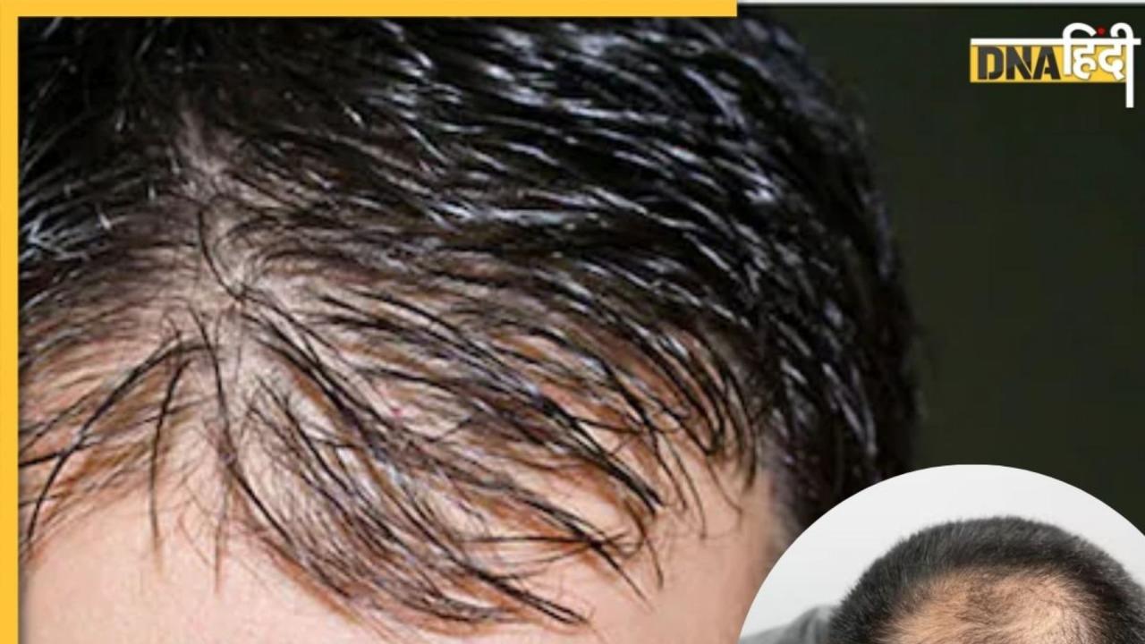 Hair Growth Tips: गंजी खोपड़ी पर बाल उगाने में मदद करेंगे ये 7 टिप्स, तेजी से होगी हेयर ग्रोथ