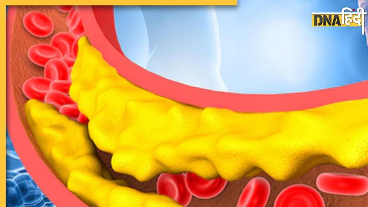 Bad Cholesterol Signs: हाई कॉलेस्ट्रॉल और नसों में जमी गंदगी का संकेत देते हैं ये 5 लक्षण, ये काम करते ही हेल्दी रहेगा हार्ट