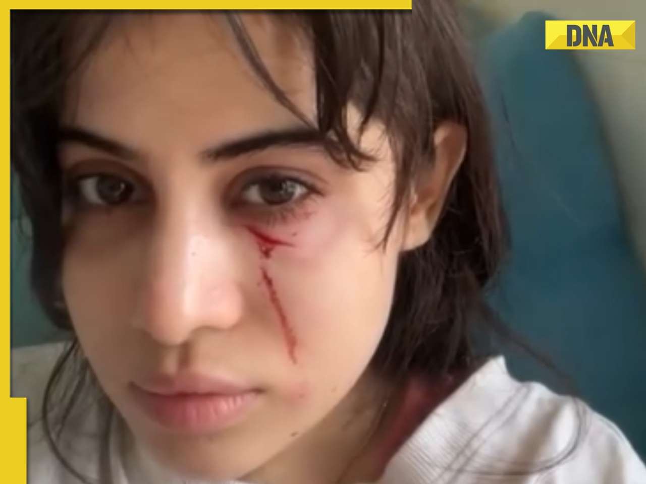 Bloodied face, bruises under eyes: Urfi Javed brutally attacked by her own...