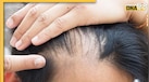 Hair Loss Problem: झेल रहे हैं बालों के झड़ने की समस्या, यहां जानें कारण और आधुनिक समाधान