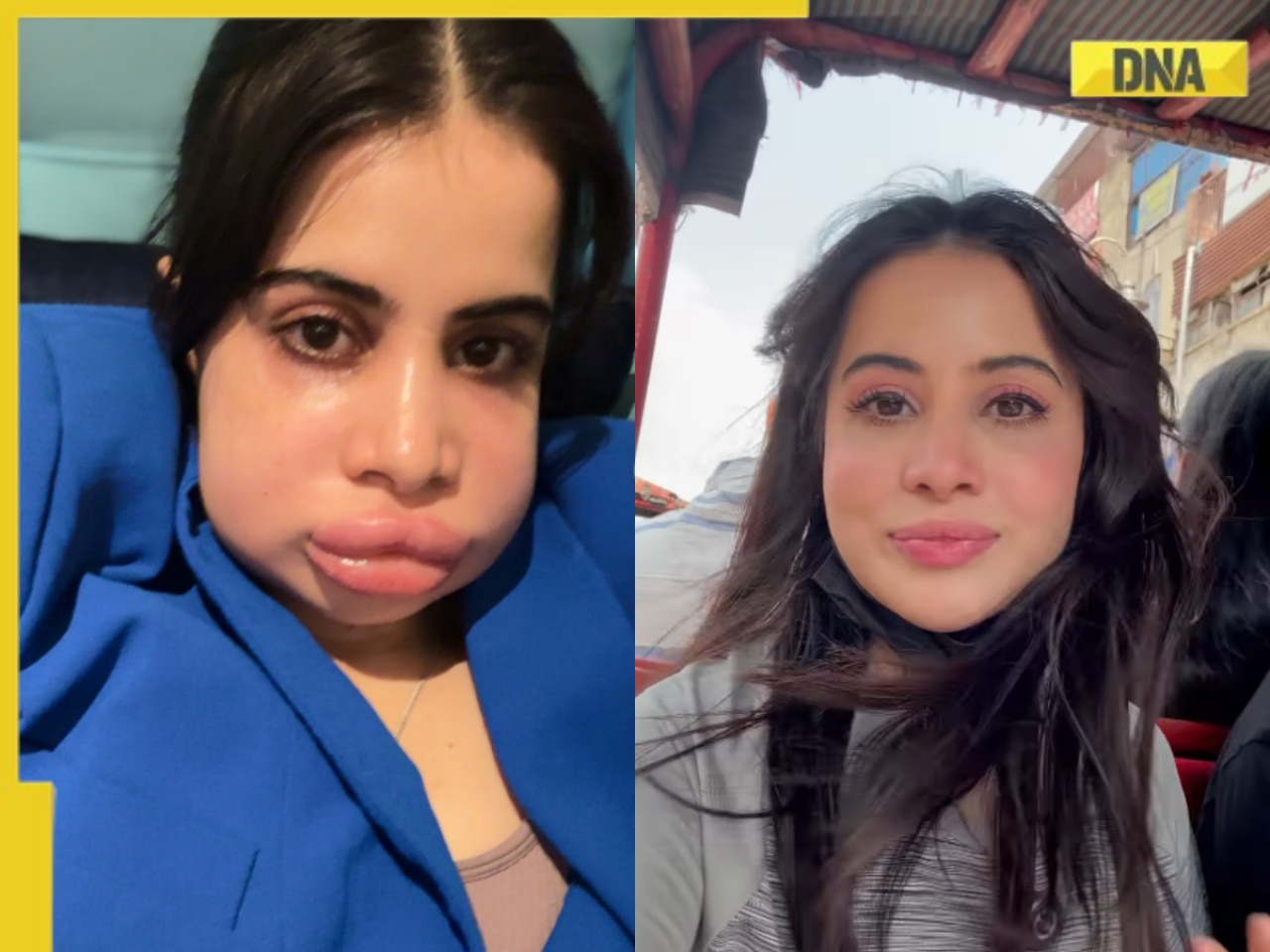 Bigg Boss OTT's Uorfi Javed flaunts 'new-me' in 'road to recovery' from swollen lips, hits back on trolls: 'So many people said so much'