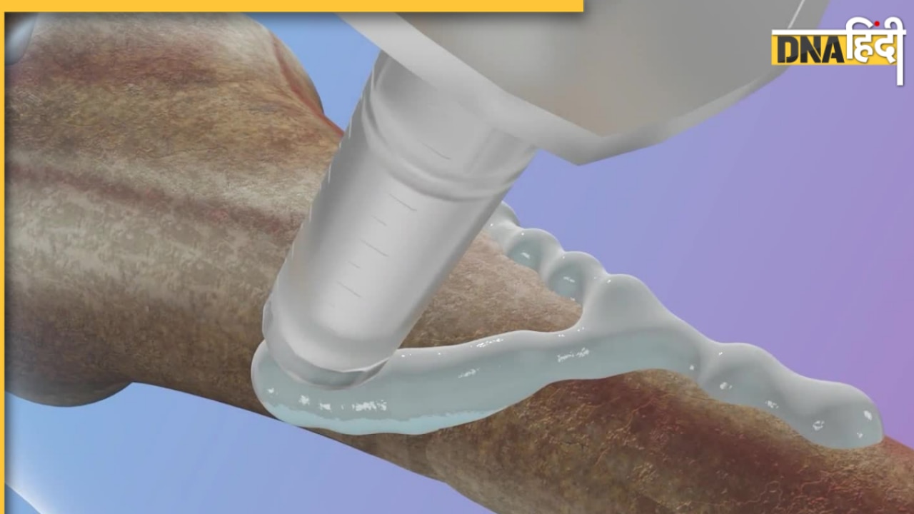 2-3 मिनट में हड्डी फिक्स! चीन ने बनाया दुनिया का पहला 'बोन ग्लू', अब नहीं पड़ेगी इम्प्लांट की जरूरत